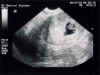 20010827-simon-ultrasound-conv-600.jpg (57885 bytes)