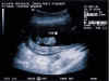 20011115-simon-ultrasound-1-600.jpg (56720 bytes)
