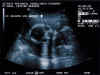 20011115-simon-ultrasound-2-600.jpg (59242 bytes)