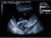 20011115-simon-ultrasound-3-600.jpg (55996 bytes)