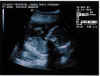 20011115-simon-ultrasound-4-600.jpg (56510 bytes)